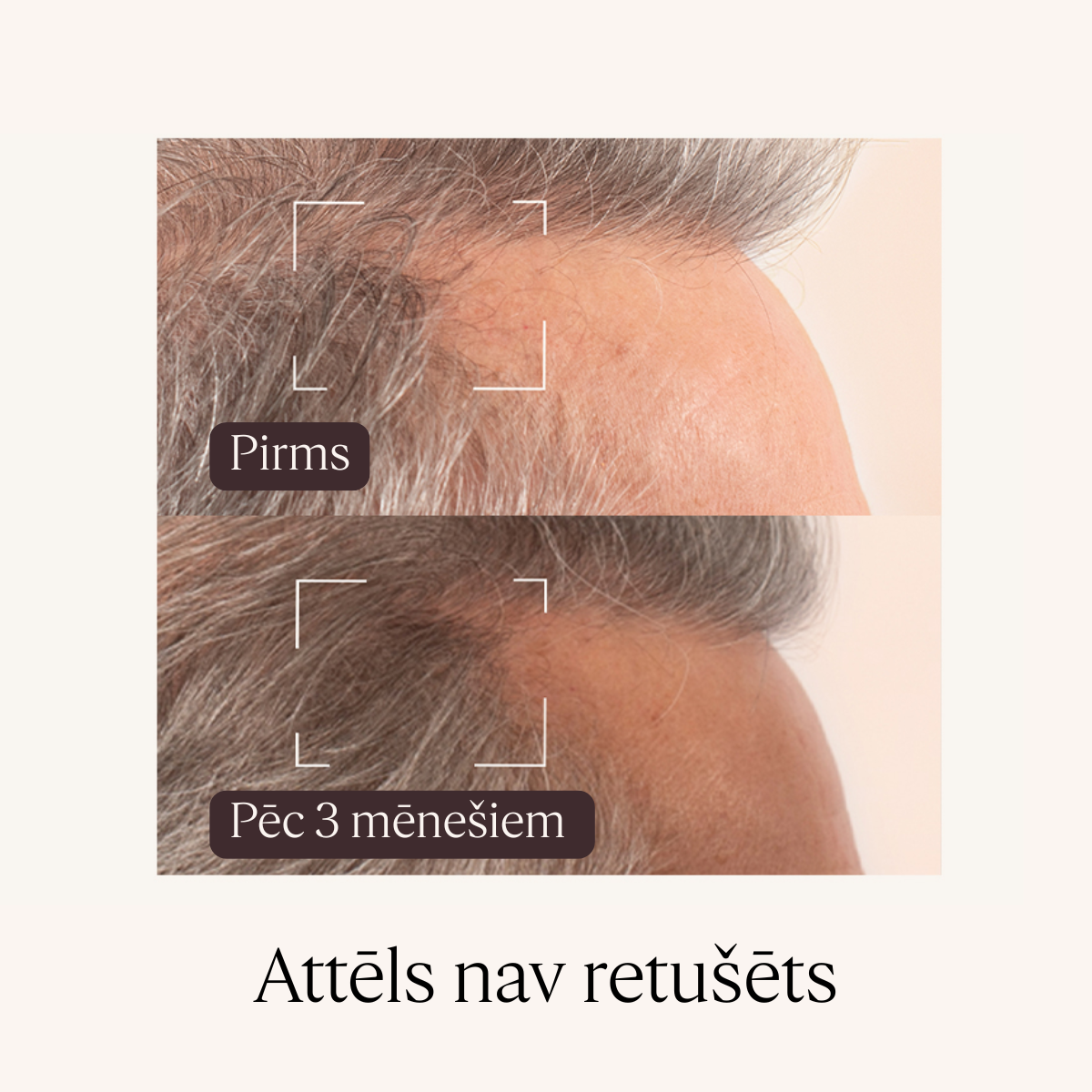 Serums matu augšanai